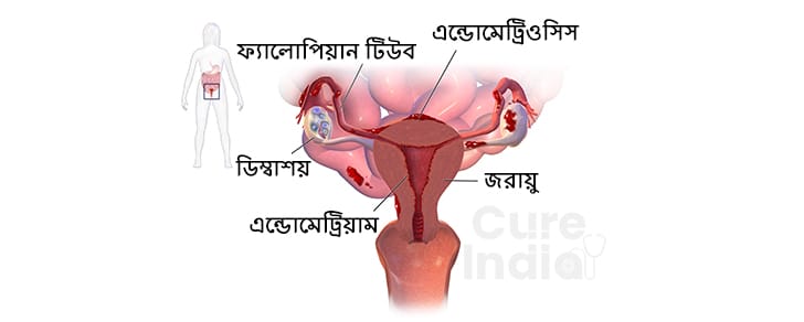 এন্ডোমেট্রিওসিস ট্রিটমেন্টের প্রথম পর্যায়